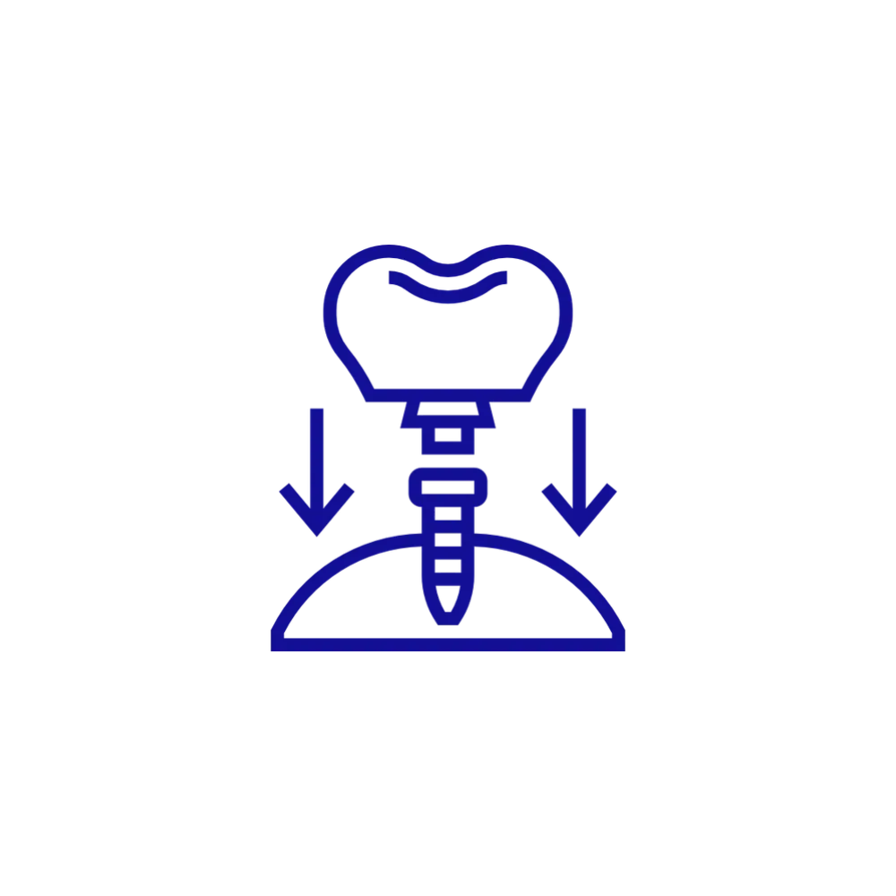 Cirurgia d’implants guiada digitalment